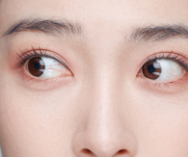 淚溝、眼袋、黑眼圈，如何分辨與診斷?插图2