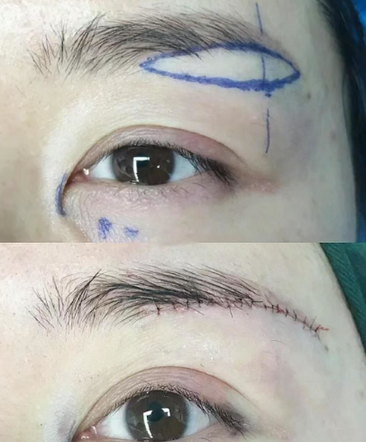 什麼是內視鏡隱痕提眉手術？提眉手術, 提眉手術恢復期, 提眉手術醫生插图