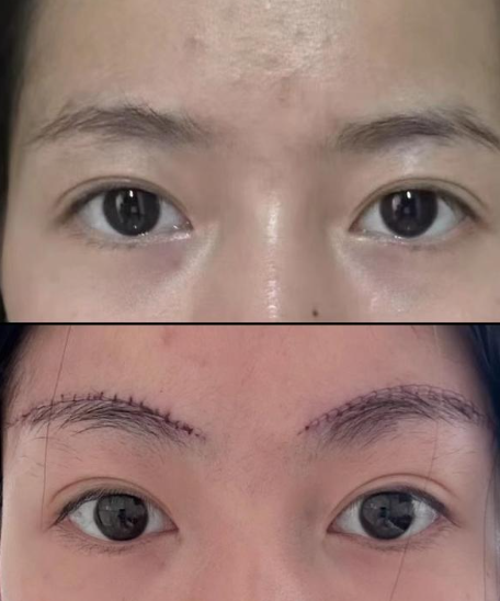 提眉手術