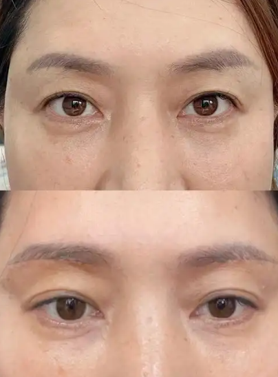 什麼是內視鏡隱痕提眉手術？提眉手術, 提眉手術恢復期, 提眉手術醫生插图2