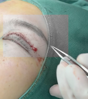 想要迷人電眼？縫、割雙眼皮怎麼選？歐式大雙適合你嗎？超全醫美攻略！插图1