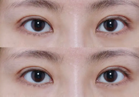 想要迷人電眼？縫、割雙眼皮怎麼選？歐式大雙適合你嗎？超全醫美攻略！插图2