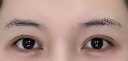 想要迷人電眼？縫、割雙眼皮怎麼選？歐式大雙適合你嗎？超全醫美攻略！插图3