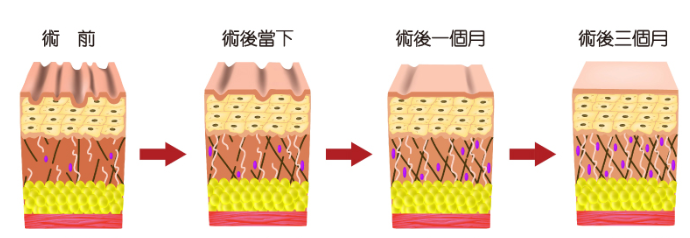 Ultherapy vs PRIME 新舊超聲刀大比拼：最新 2.0 版真係唔痛啲？一文睇清抗老原理與效果！插图